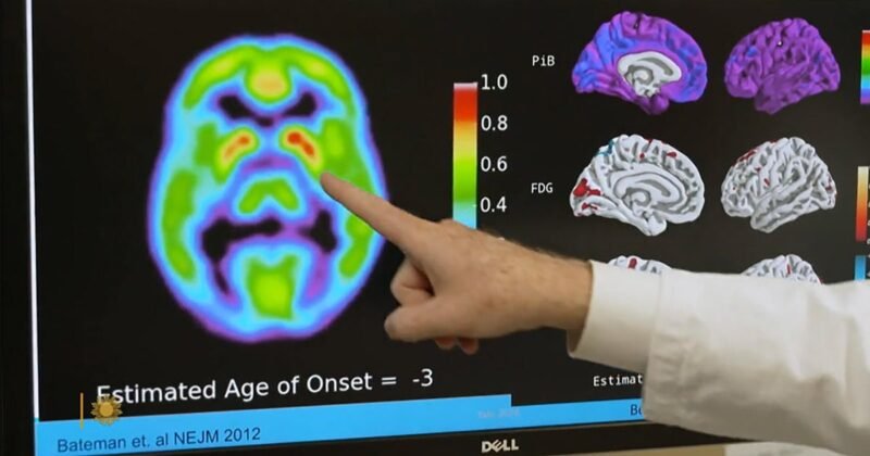 Promising clinical trials in Alzheimer’s prevention